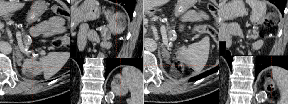 03_Case_Zürich_01_2022_Pre-Post-Ablation