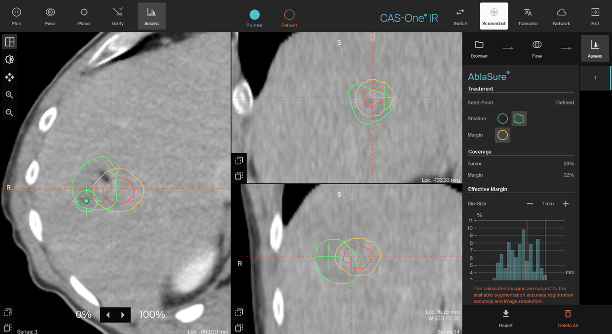 1st ablation