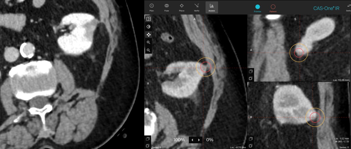 2-lesion