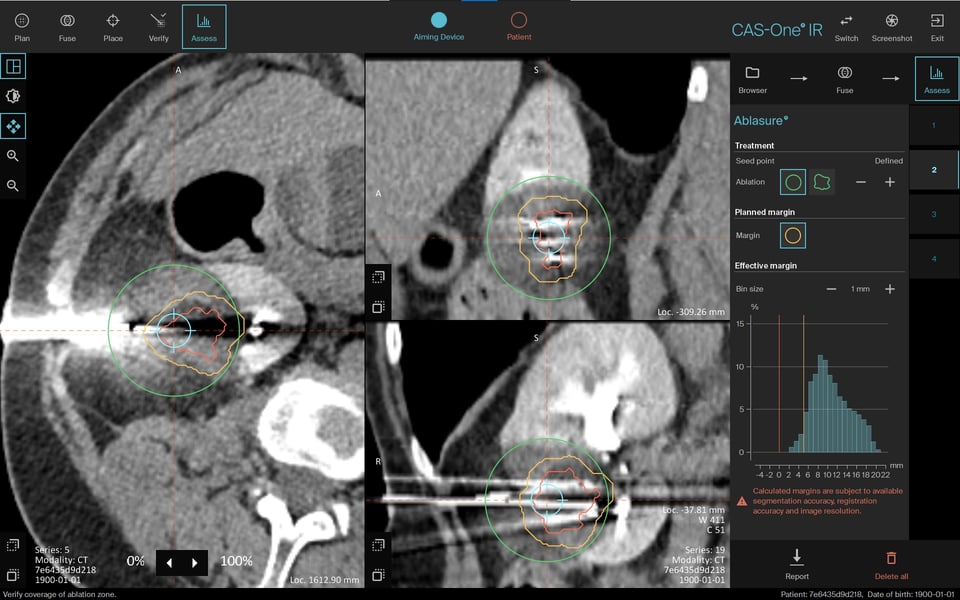Cryoablation of large kidney lesion postnephrectomy to preserve renal