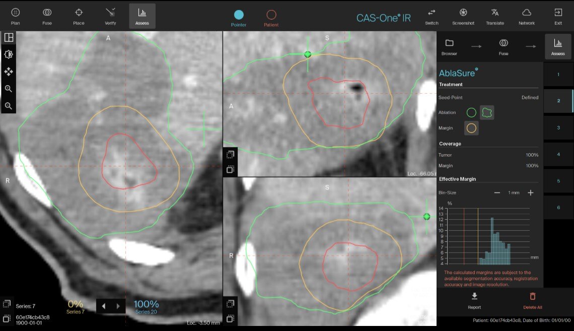 Ablasure 1cm