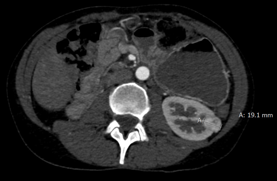 Navigierte Nierenablation 01