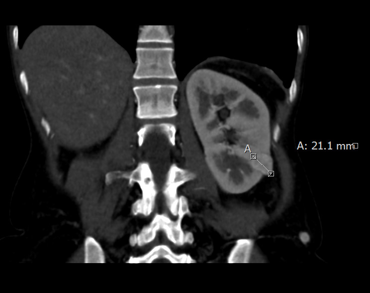 Navigierte Nierenablation 02