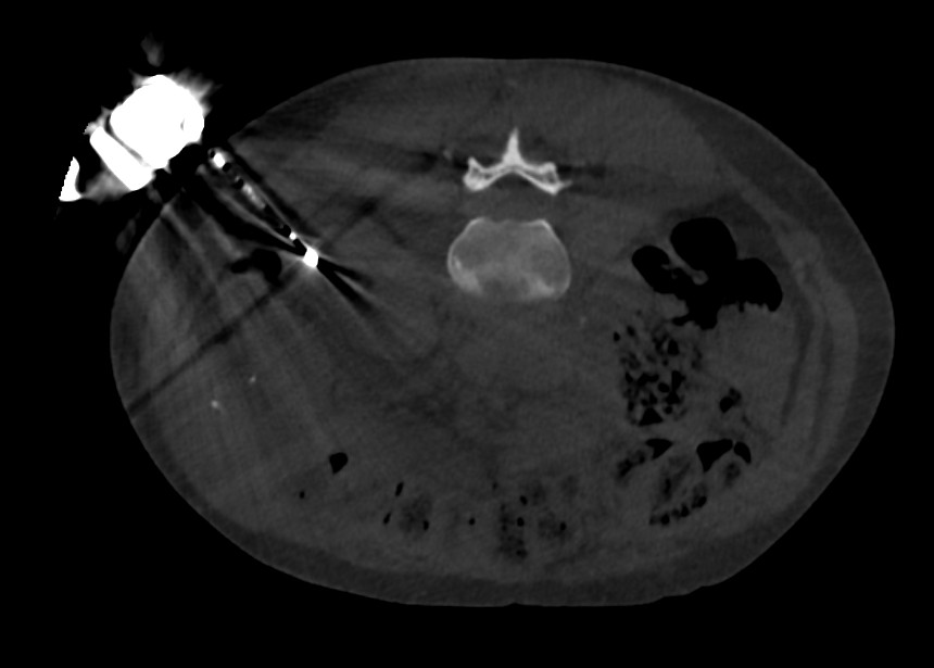 Navigierte Nierenablation 03
