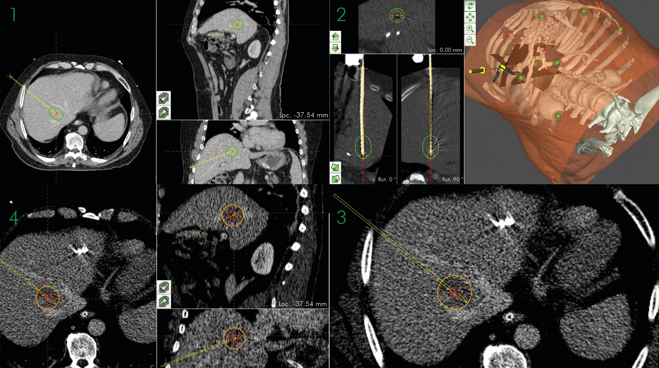 CTguided ablation of a deep seated hepatic tumor in segment VIII