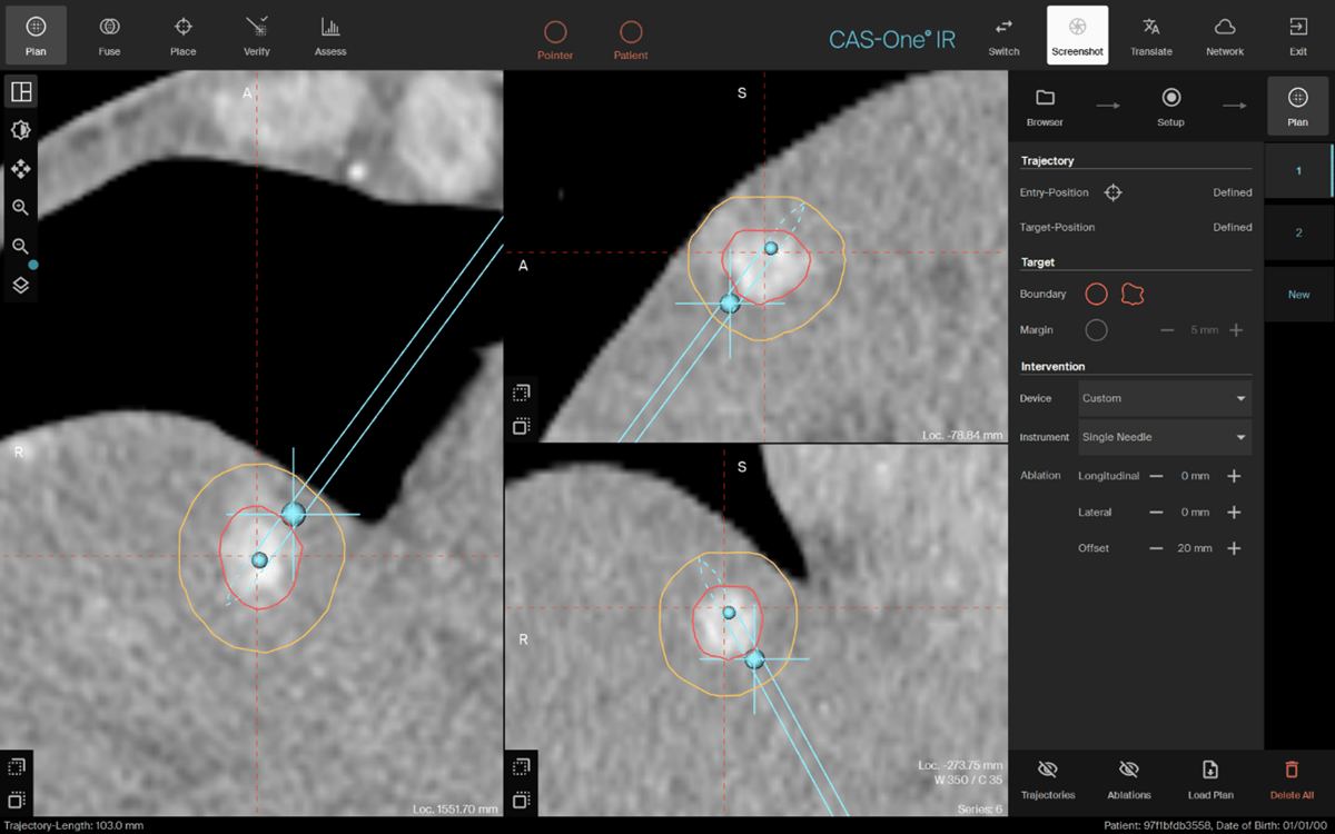 Dijon Planning Scan Biopsy