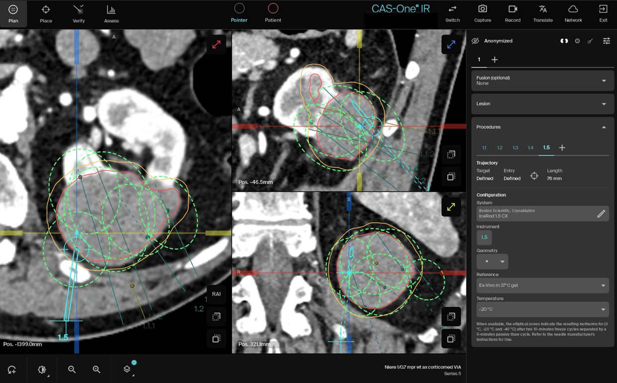 Kidney Planning 1