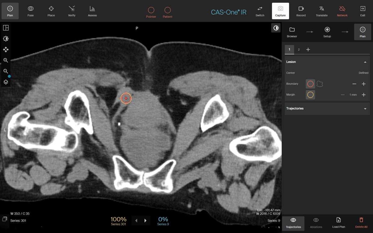 Lesion Invisible on CT-1