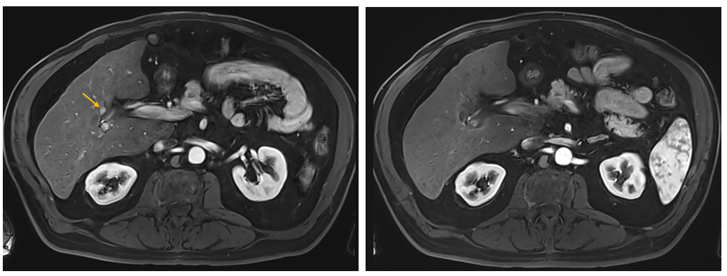 MRI PRE POST