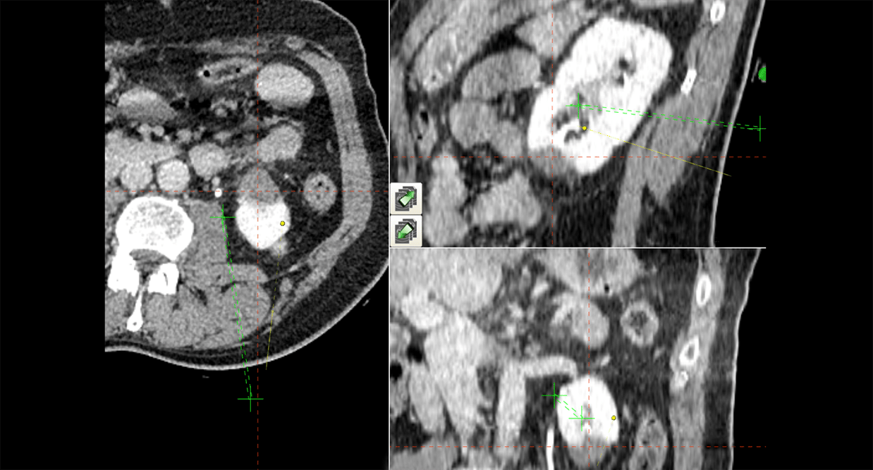 MWApostablation 1500x809