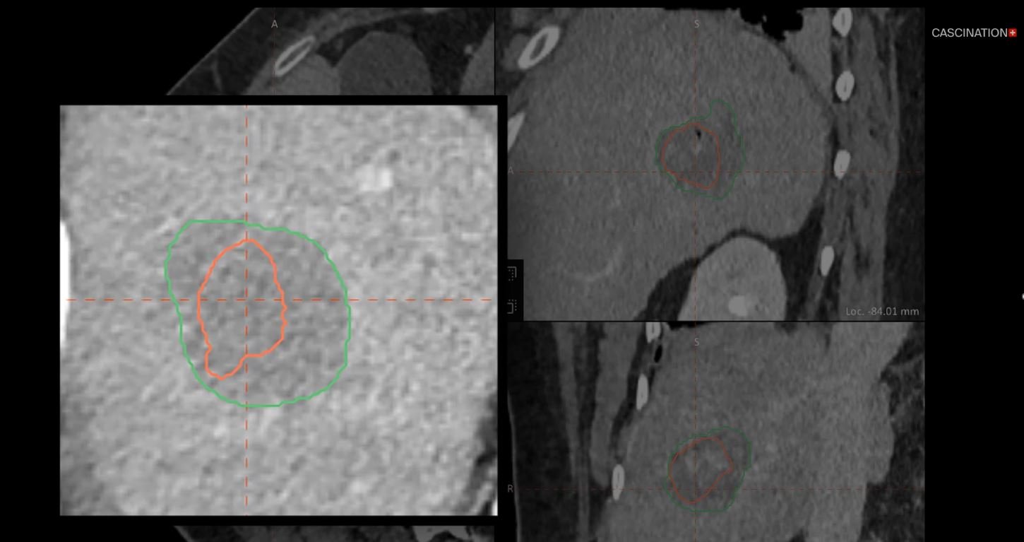 Next Gen tumor and necrosis