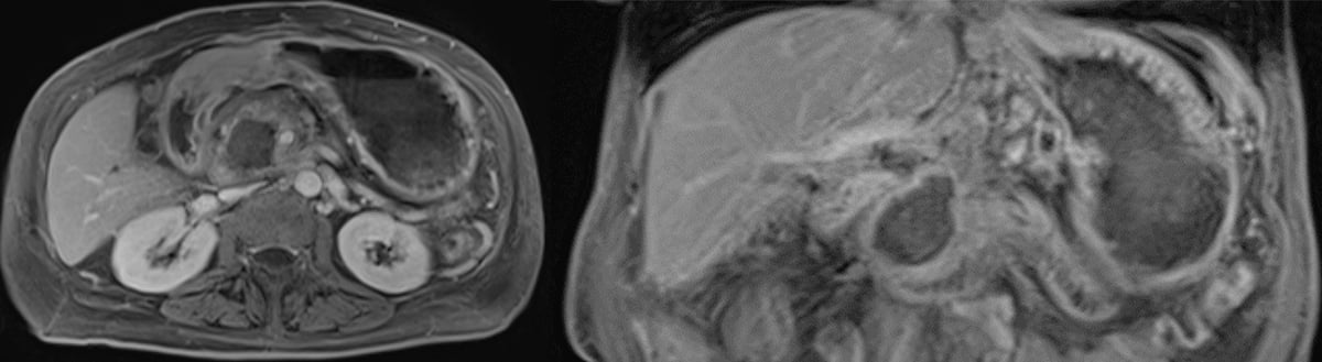 TopCaseIntraHepatic