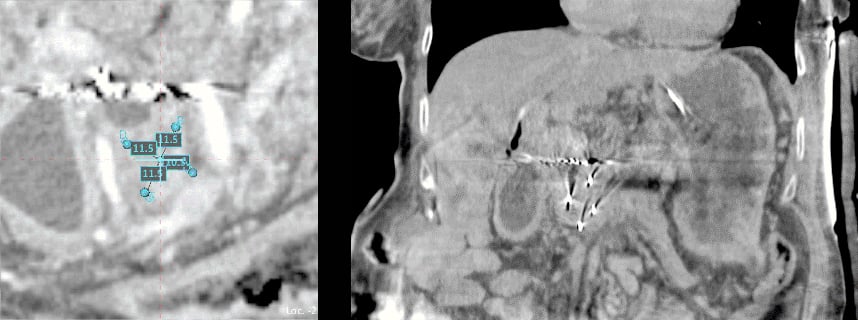 TopCaseIntraHepatic2