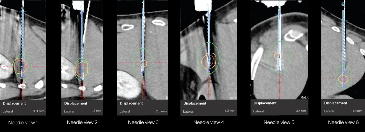 layout-compilation-needle-view