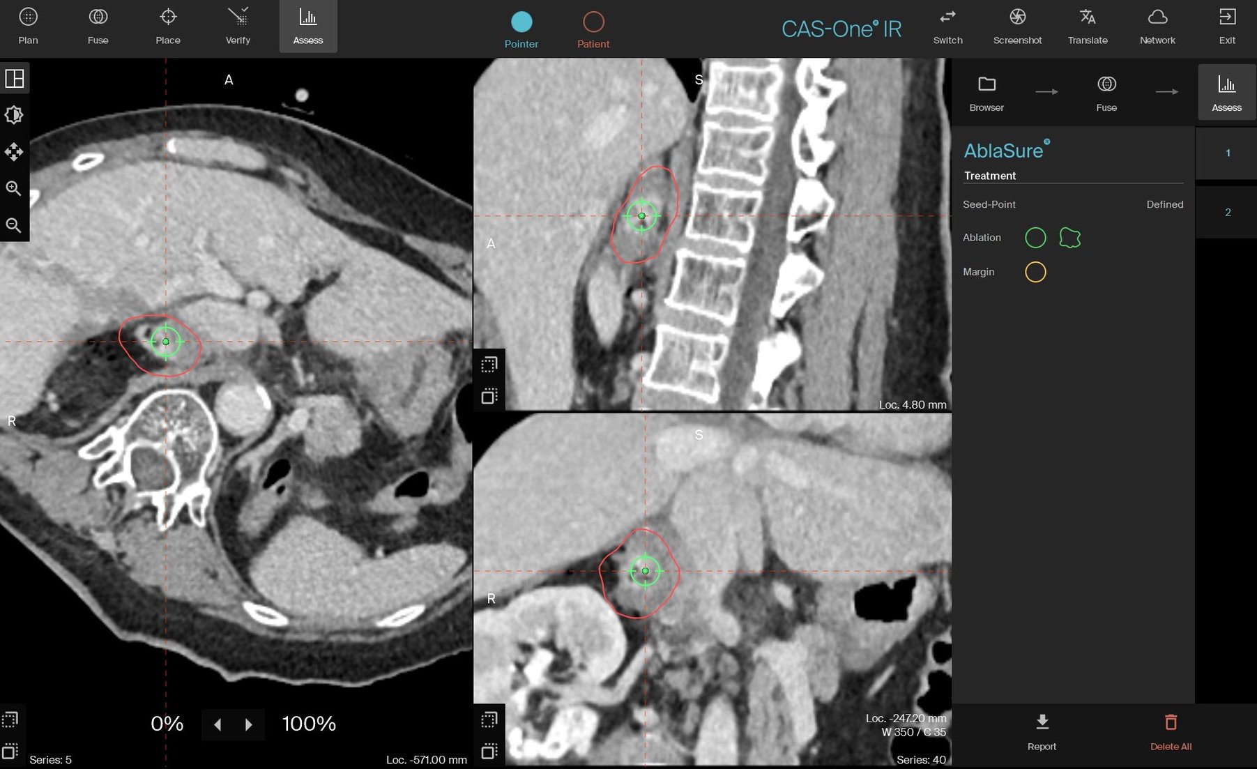 Devascularization Multi-trajectory MWA of the adrenal gland