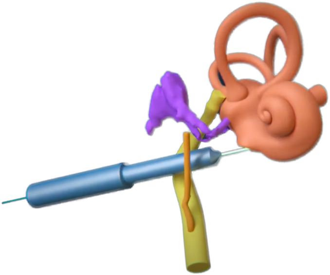 Hearo_Insertion_Angle-1 Hearo_Insertion_Angle-1