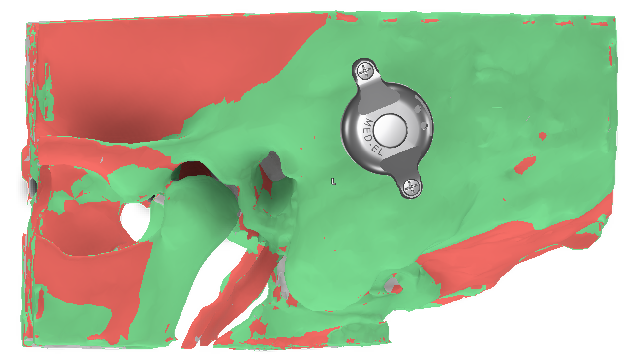 Find the ideal implant position with a tailored thickness map