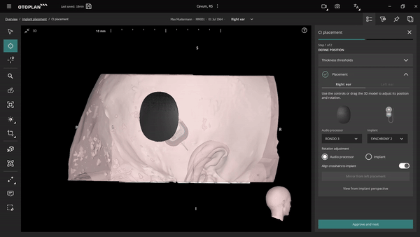 Perfect the implant placement by planning it virtually