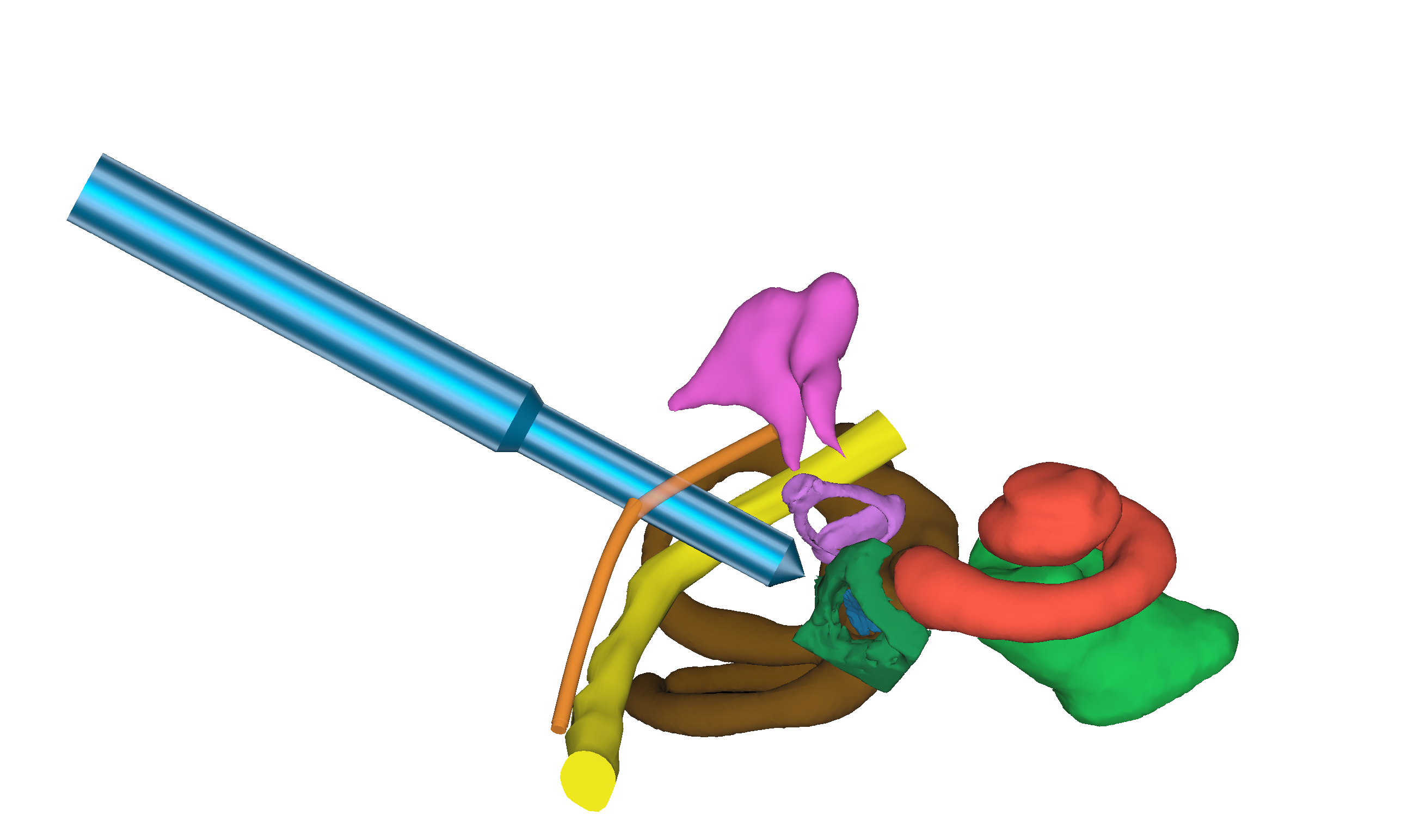 Strategize how to safely access the cochlea