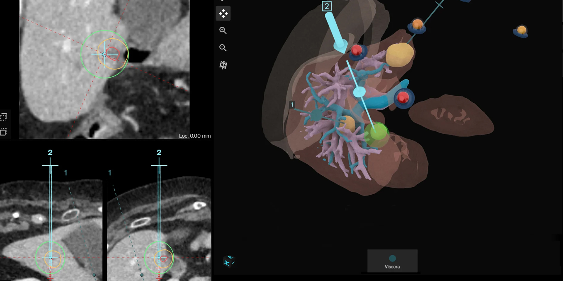 MWA of five invisible liver lesions with MRI/CT fusion